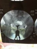 试管婴儿促排卵期间吃啥水果可以提高卵泡质量？试管婴儿促排卵期间食用这些水果需要注意什么？